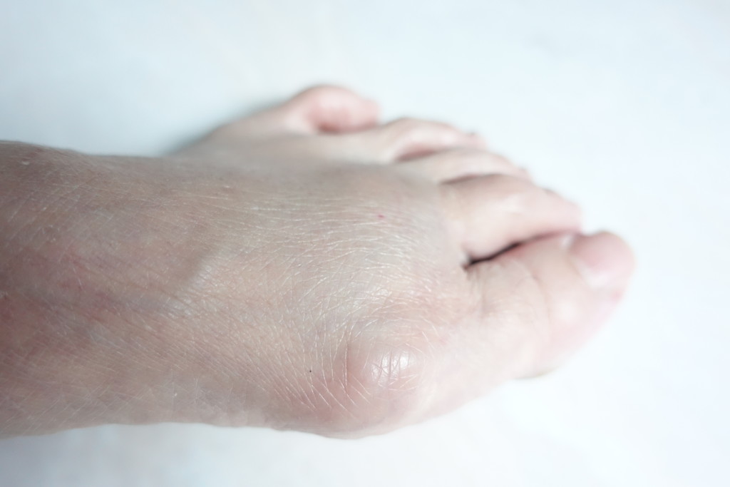 My mother's bunion is a Stage 1 bunion, according to Png.