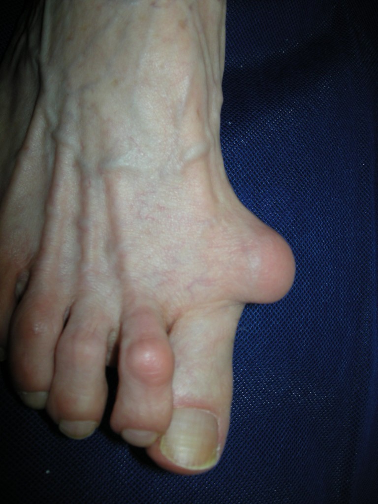 A more painful looking bunion. [Photo taken from www.alignmentrescue.com]